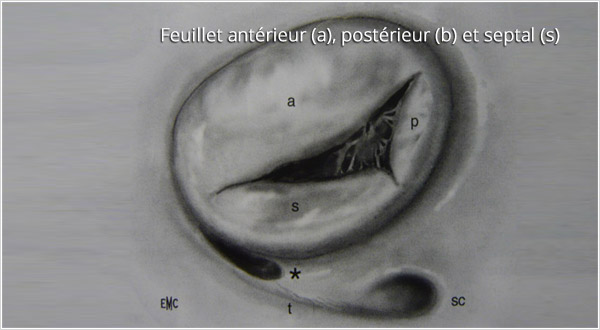 Chirurgie de la valve tricuspide  Unité de cardiologie et de chirurgie  cardiaque Jacques Cartier