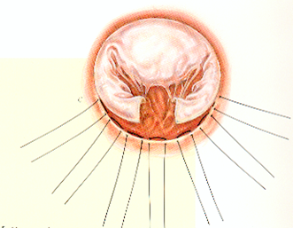 resection-quadrangulaire-avec-plastie-de-glissement-1