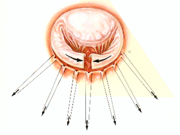 resection-quadrangulaire-avec-plastie-de-glissement-2