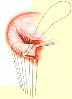 resection-quadrangulaire-avec-plastie-de-glissement-3