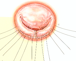 resection-quadrangulaire-avec-plastie-de-glissement-4