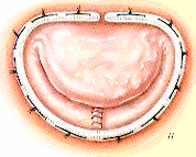 resection-quadrangulaire-avec-plastie-de-glissement-5