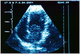 Echocardio-1