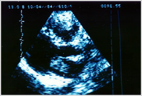 Echocardio-2