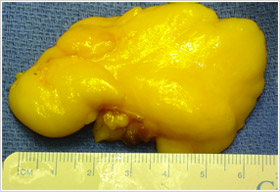 lipome-vd-2