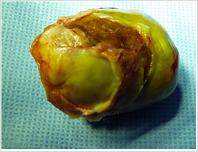 myxome-1
